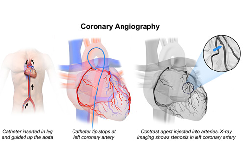 How is the Coronary Angiography Performed