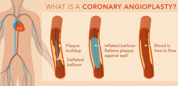 what is Coronary Angioplasty
