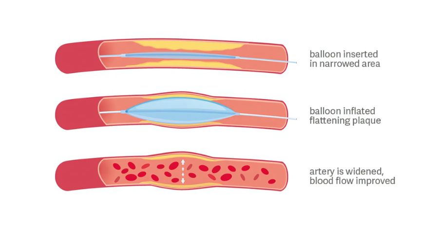 How is the Coronary Angioplasty Performed