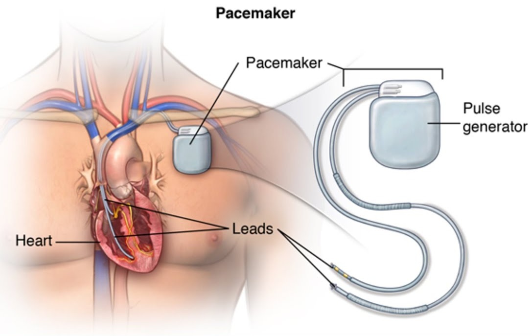 Parts of a Pacemaker