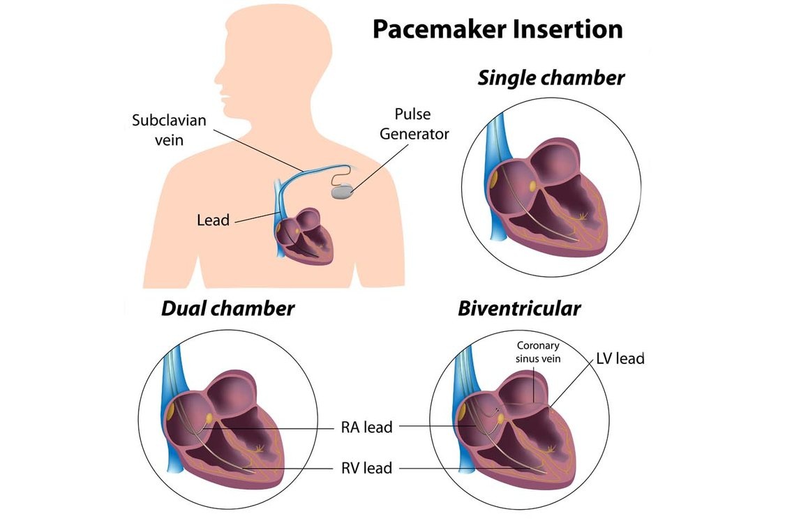 Types of Pacemakers