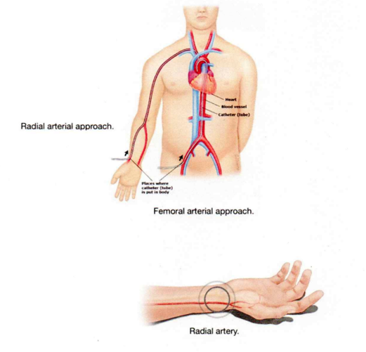 How is Radial Angioplasty Performed