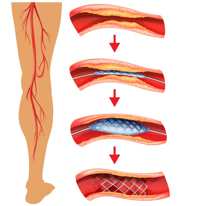 How is the Coronary Angiography Performed