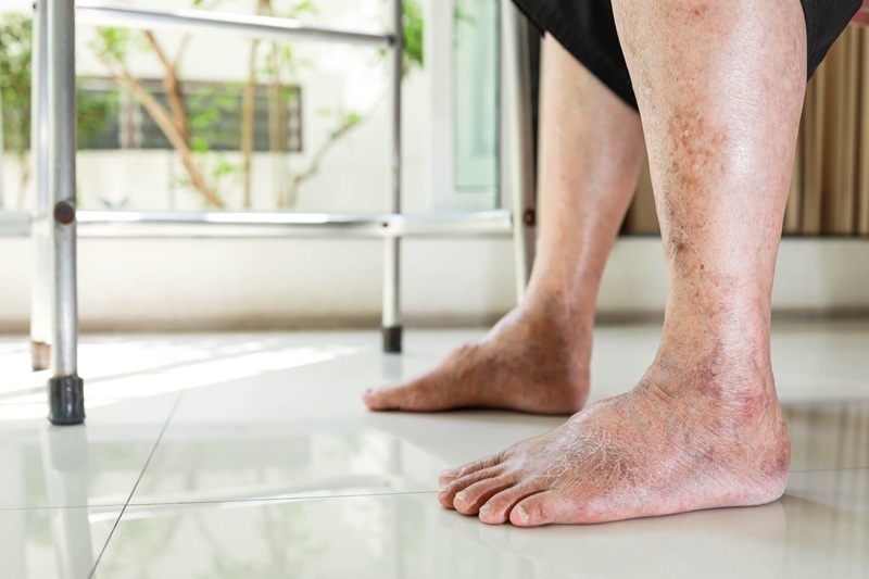Peripheral Angioplasty in Andheri, Mumbai