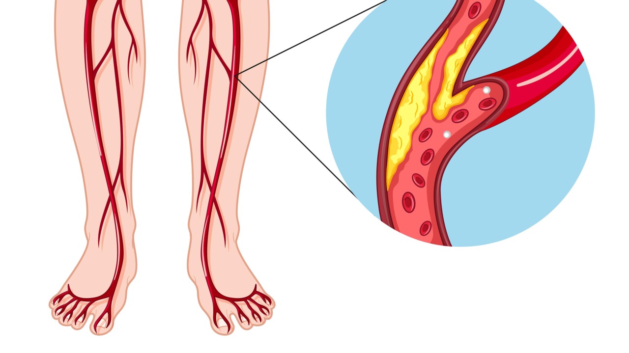 What is Peripheral Angioplasty