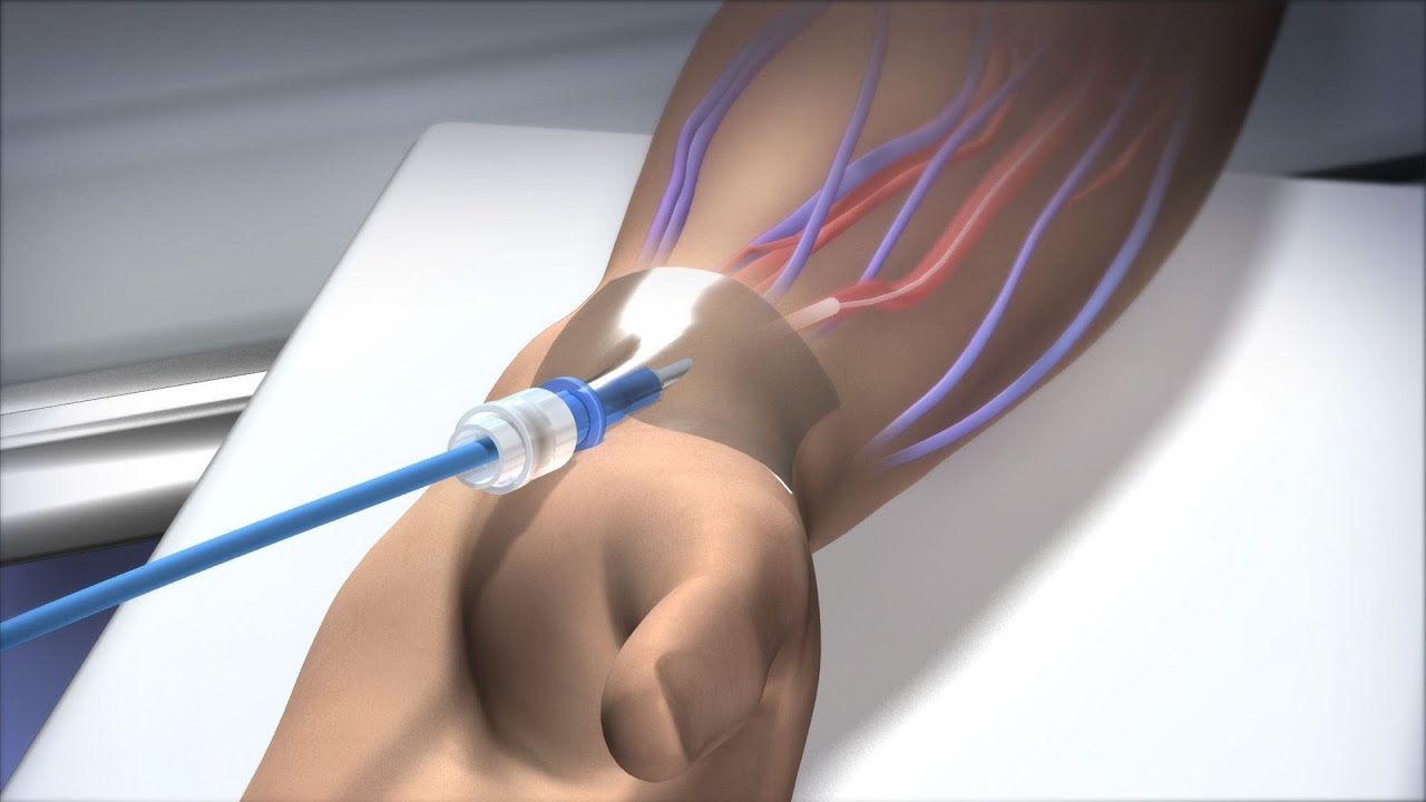 What is Radial Angioplasty
