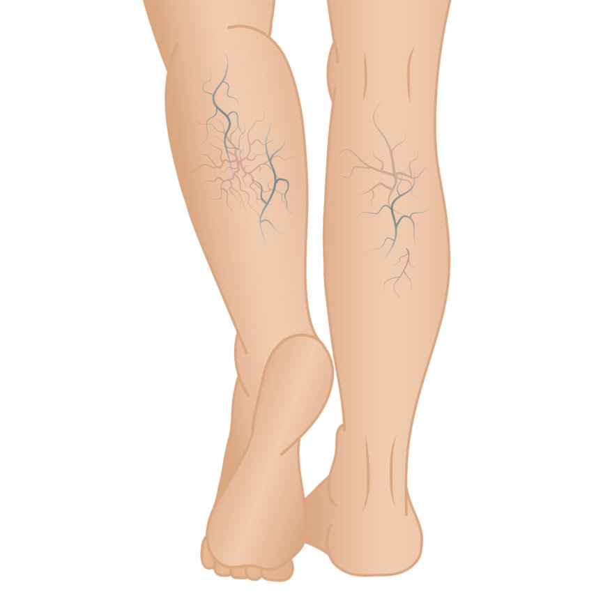 Who Should Consider Coronary Angiography