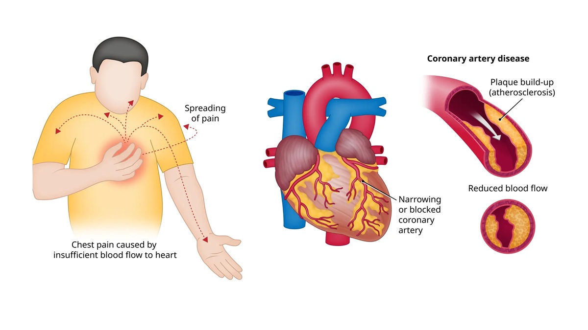 Who Should Consider Radial Angioplasty